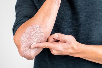 Εφαρμογή της κρέμας στην περιοχή του δέρματος που έχει υποστεί βλάβη από ψωρίαση