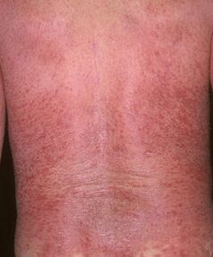 Ερυθροδερμία