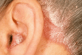 αιτίες της ψωρίασης